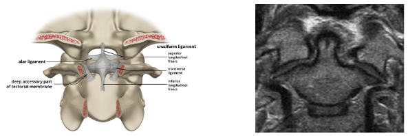 Image result for torn static stabilizer ligaments of the craniocervical junction