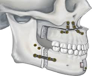 Image result for complications of MMA surgery (maxillomandibular advancement):