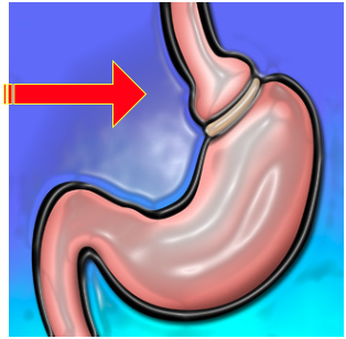 Image result for complications of Bariatric Surgery: